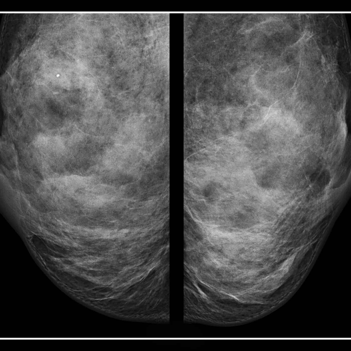 Breast-Cancer-2.jpeg