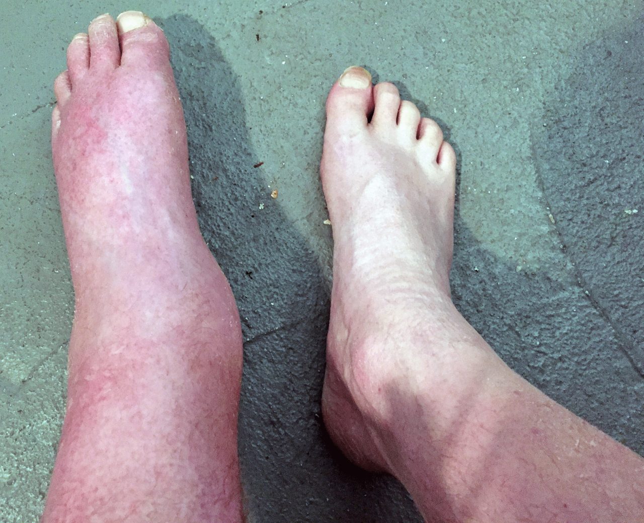 Edema.jpeg